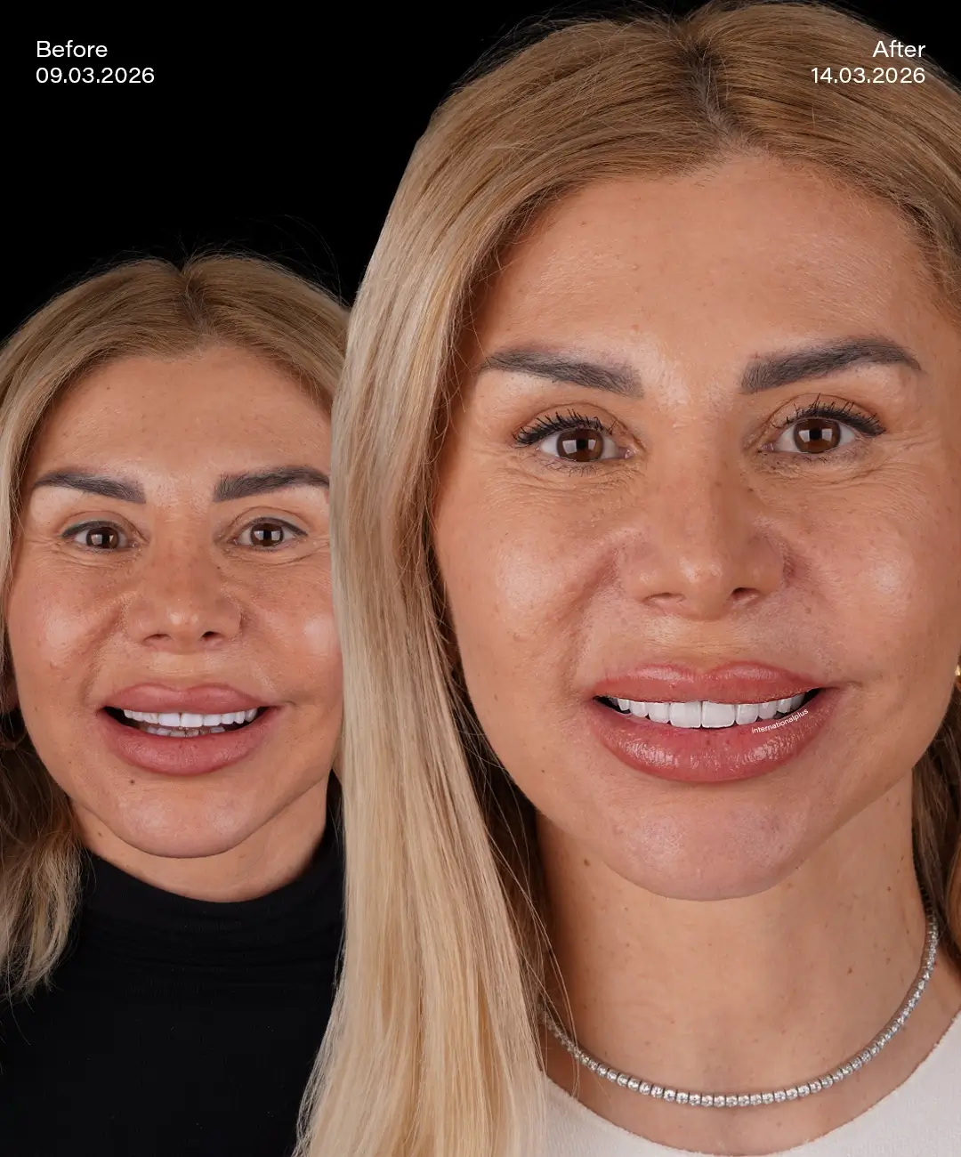 Emax Veneers Before After 1