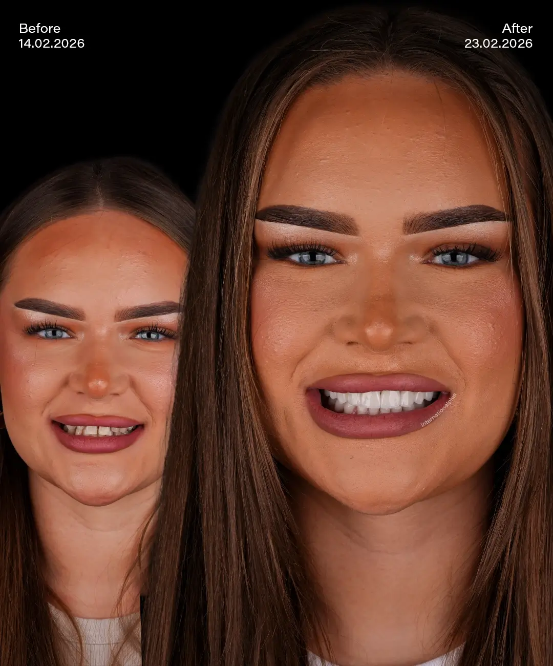 Emax Veneers Before After 2