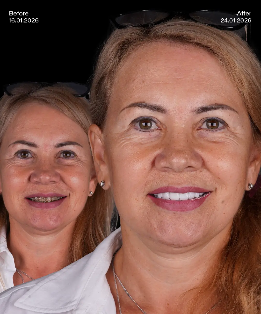 Emax Veneers Before After 3