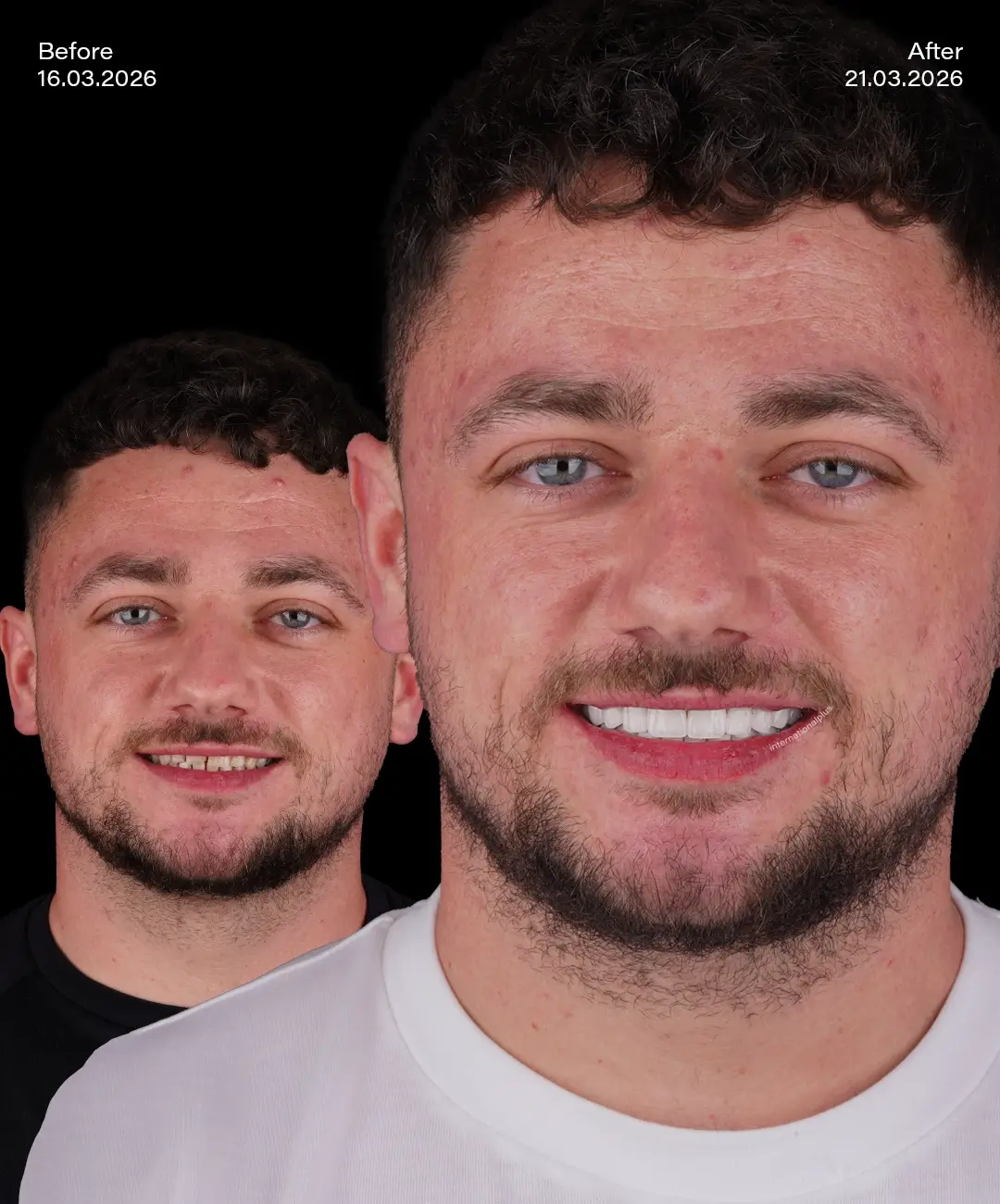 Emax Veneers Before After 4