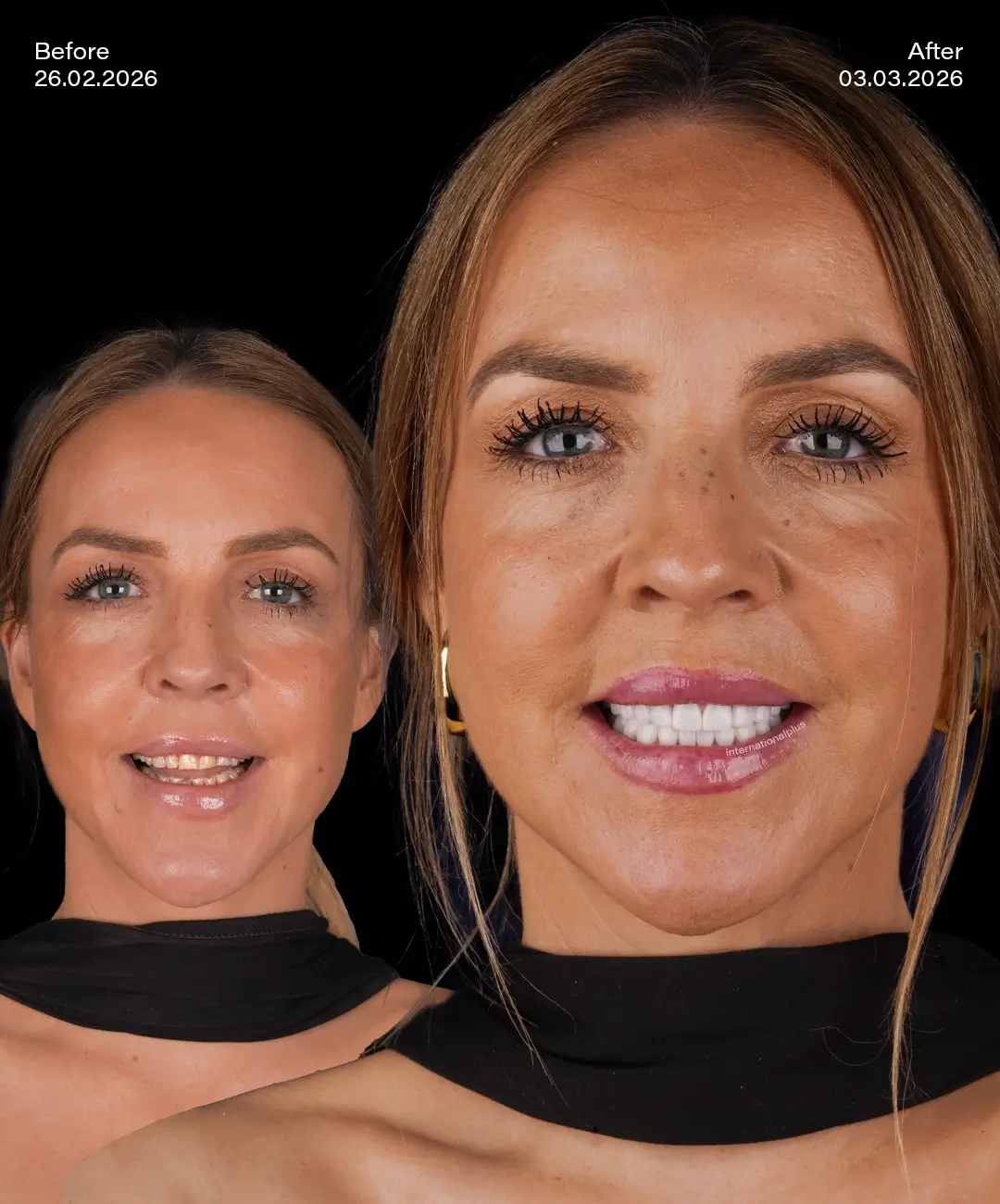 Emax Veneers Before After 5