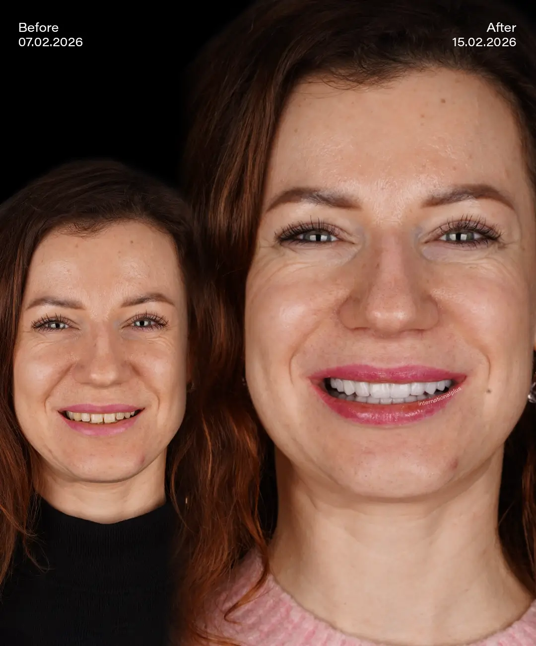 Emax Veneers Before After 6