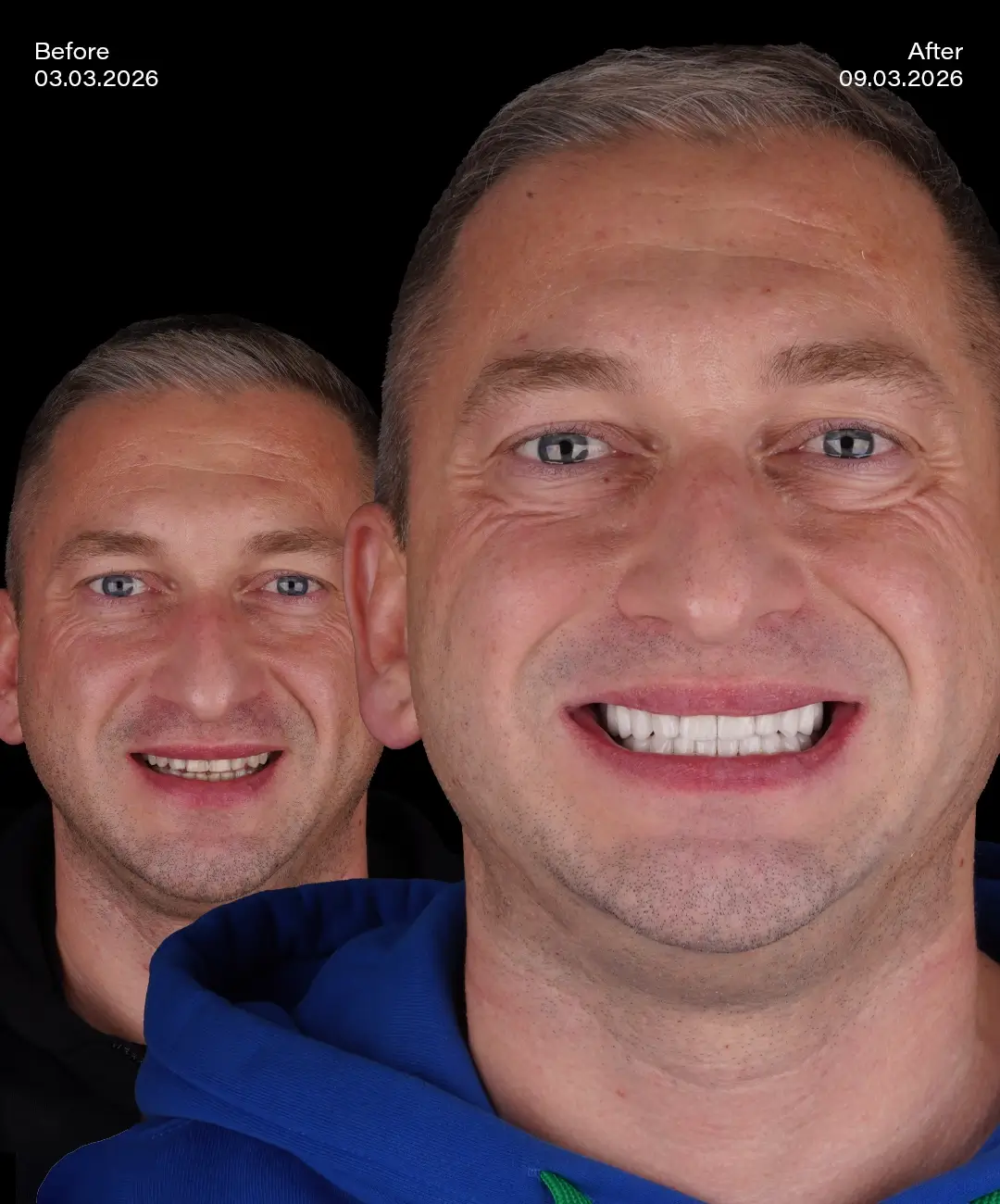 Emax Veneers Before After 7