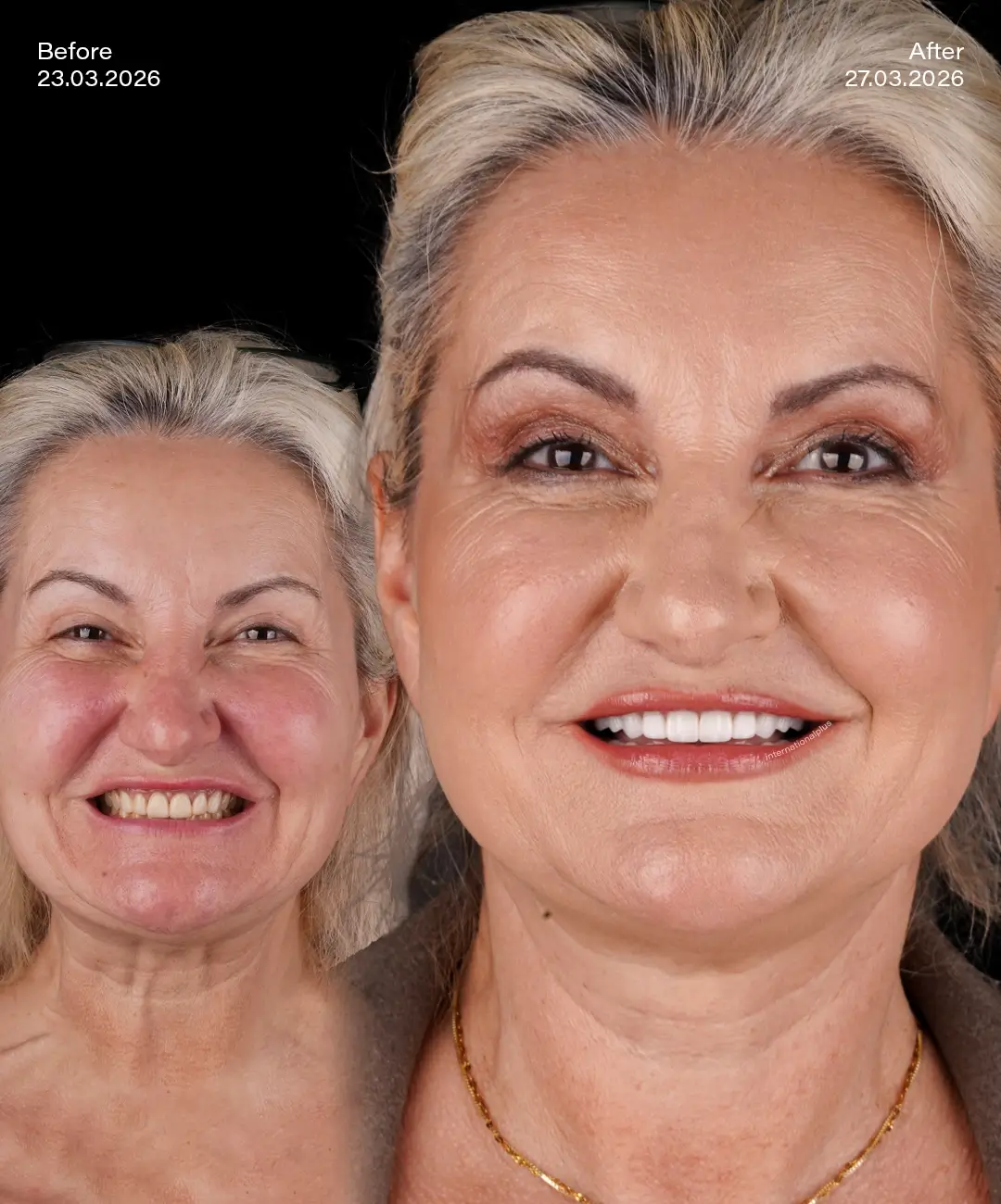 Emax Veneers Before After 8