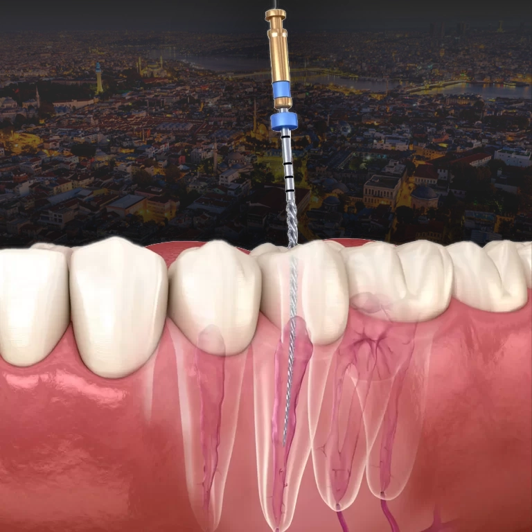 Endodontics in Turkey Istanbul