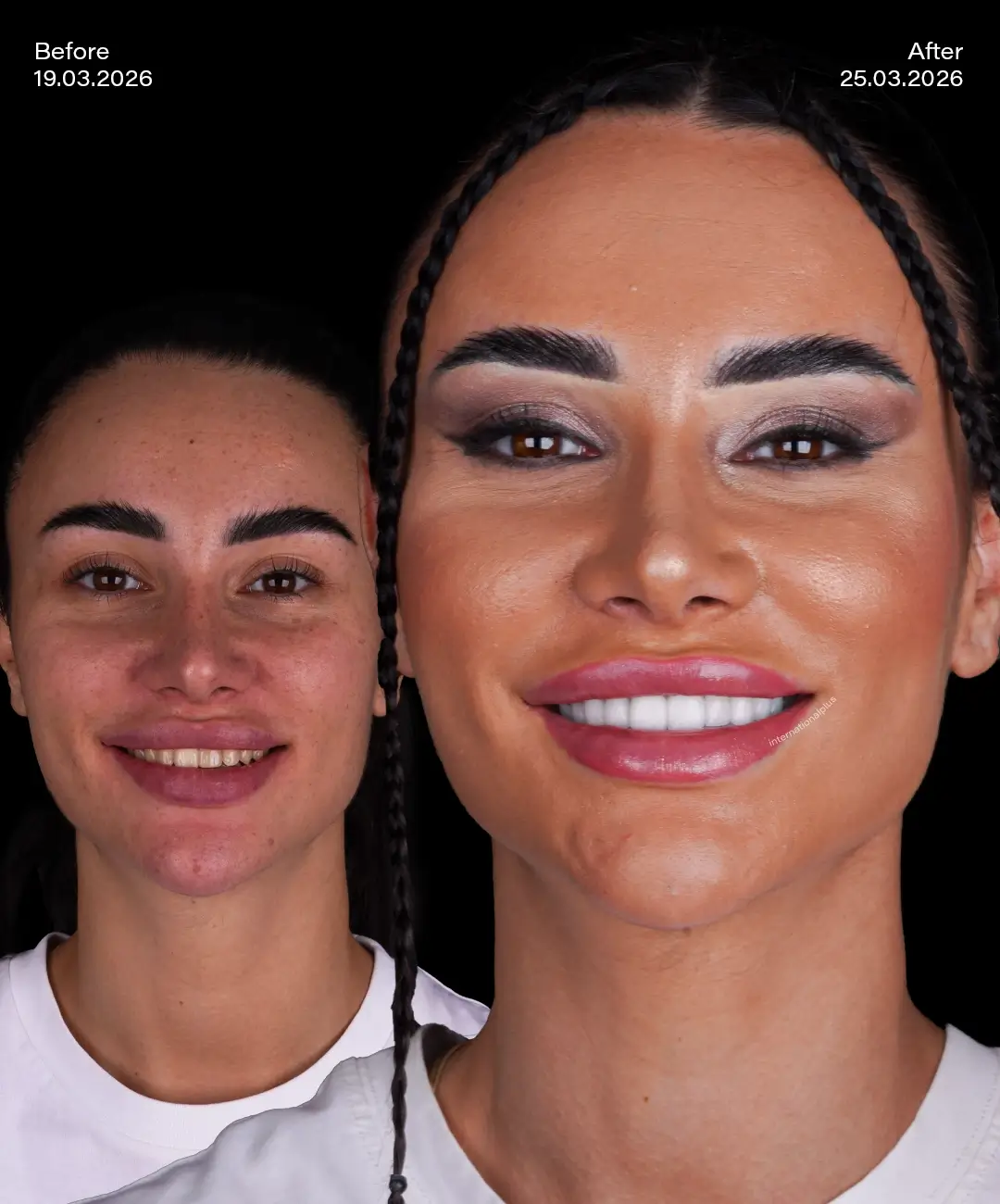 Lamine Veneers Before After 6