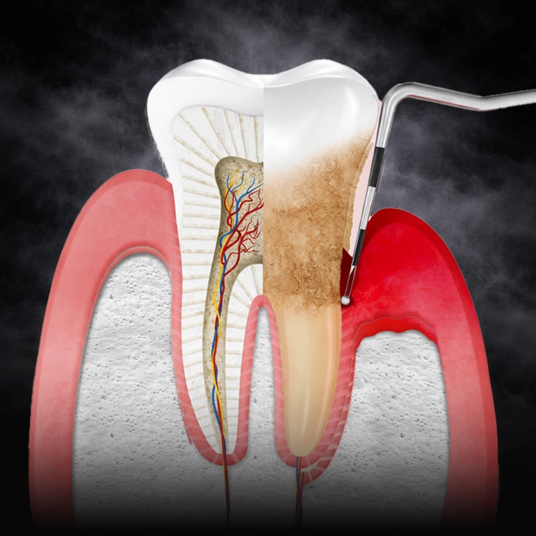 Periodontology in Turkey Istanbul
