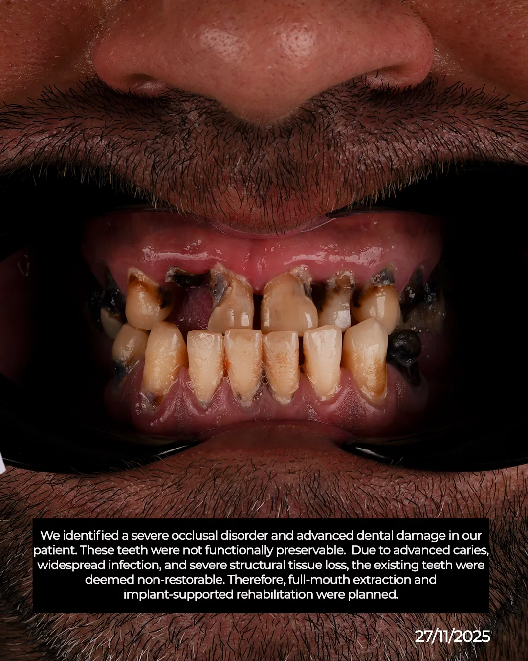 Same Day Temporary Teeth and Patient Comfort