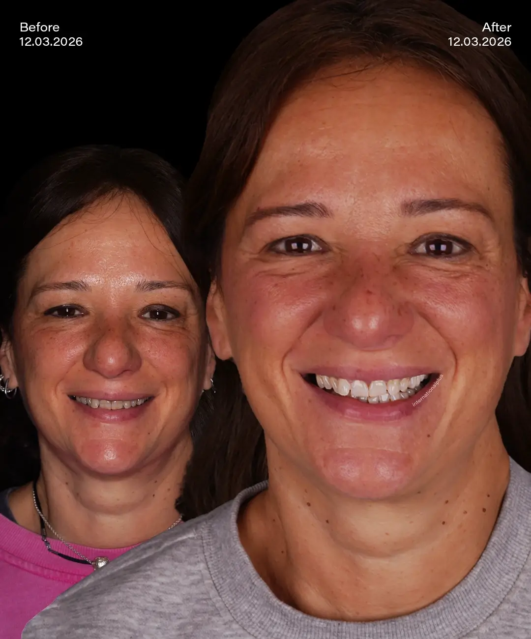 Teeth Whitening Before After 1