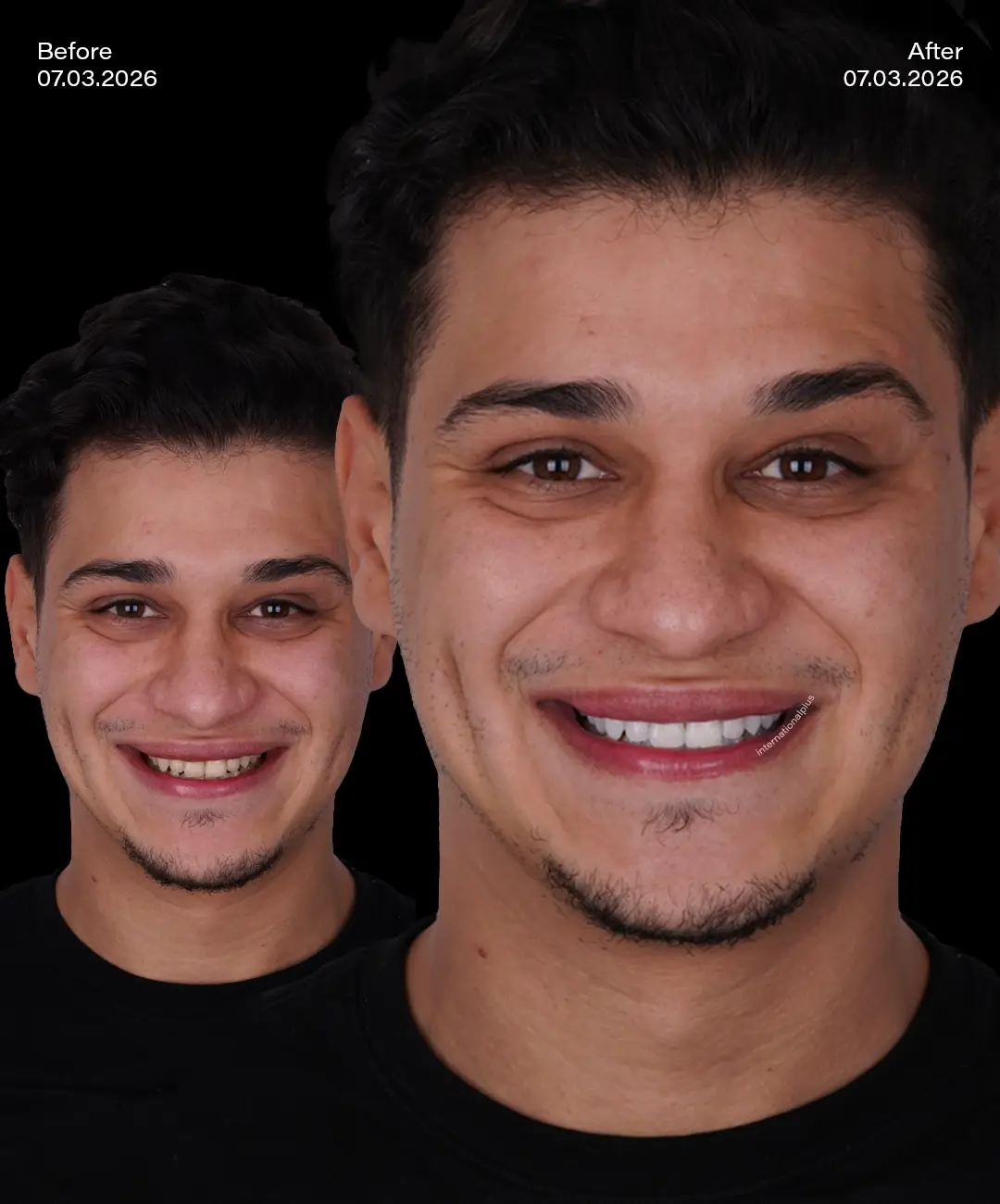 Teeth Whitening Before After 2