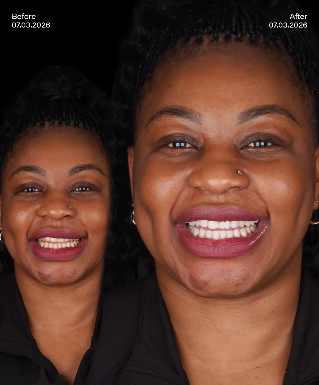 Teeth Whitening Before After 3