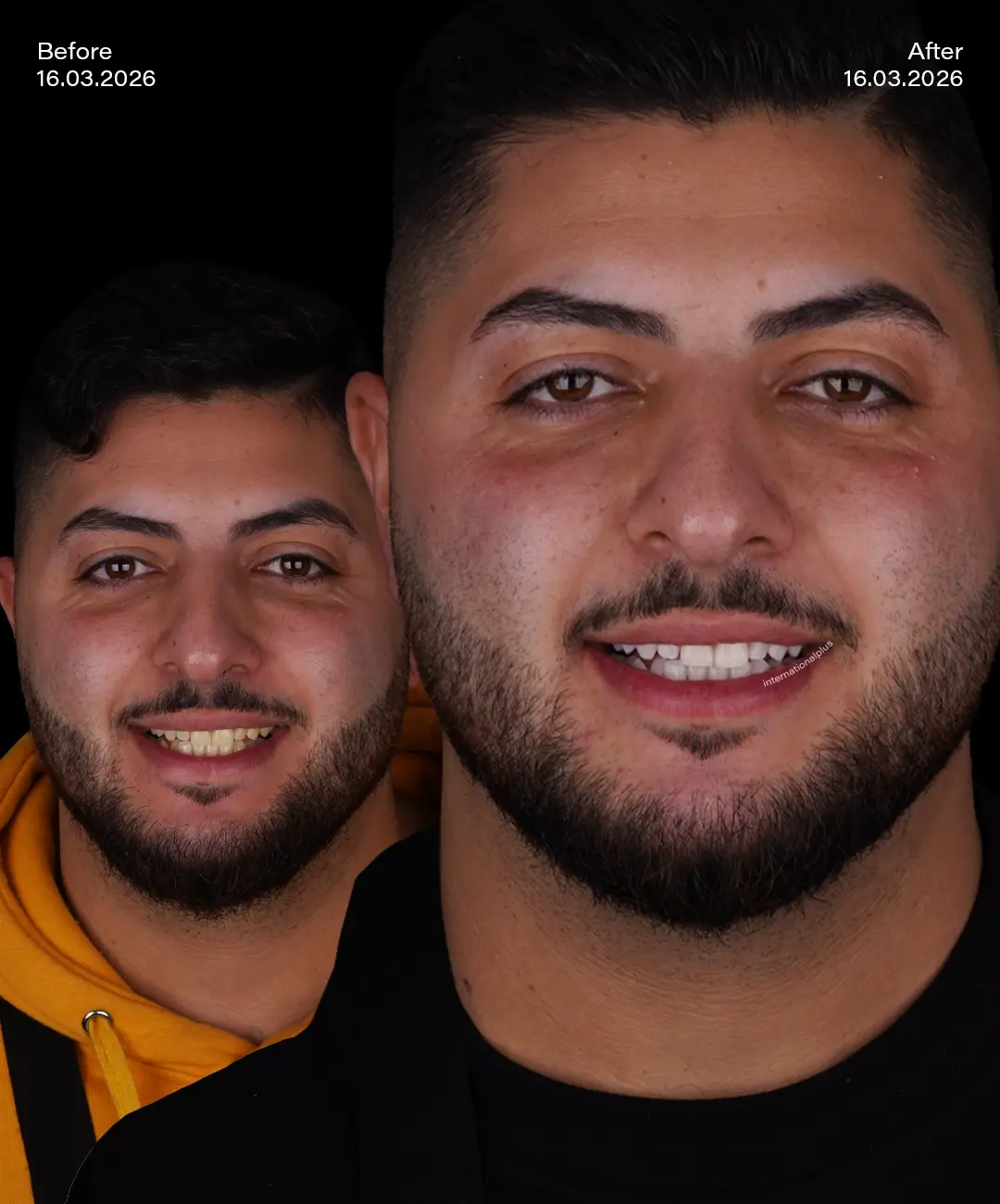 Teeth Whitening Before After 4