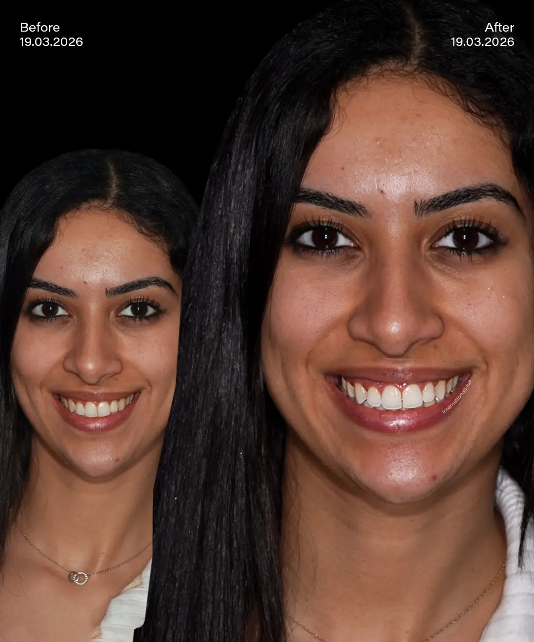 Teeth Whitening Before After 5