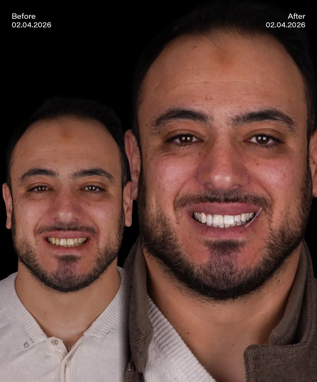 Teeth Whitening Before After 6