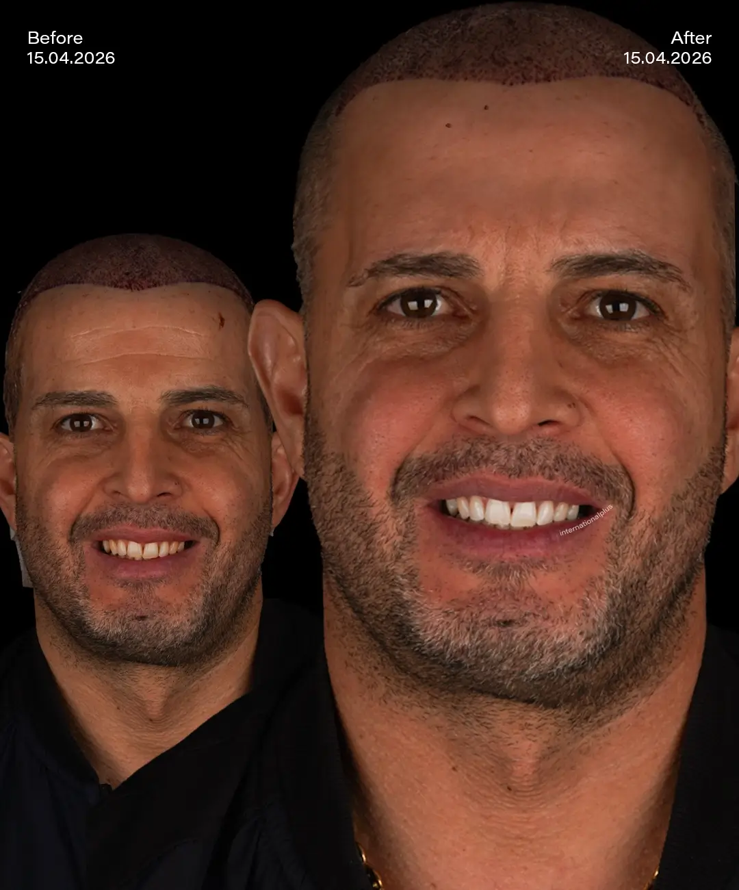 Teeth Whitening Before After 7