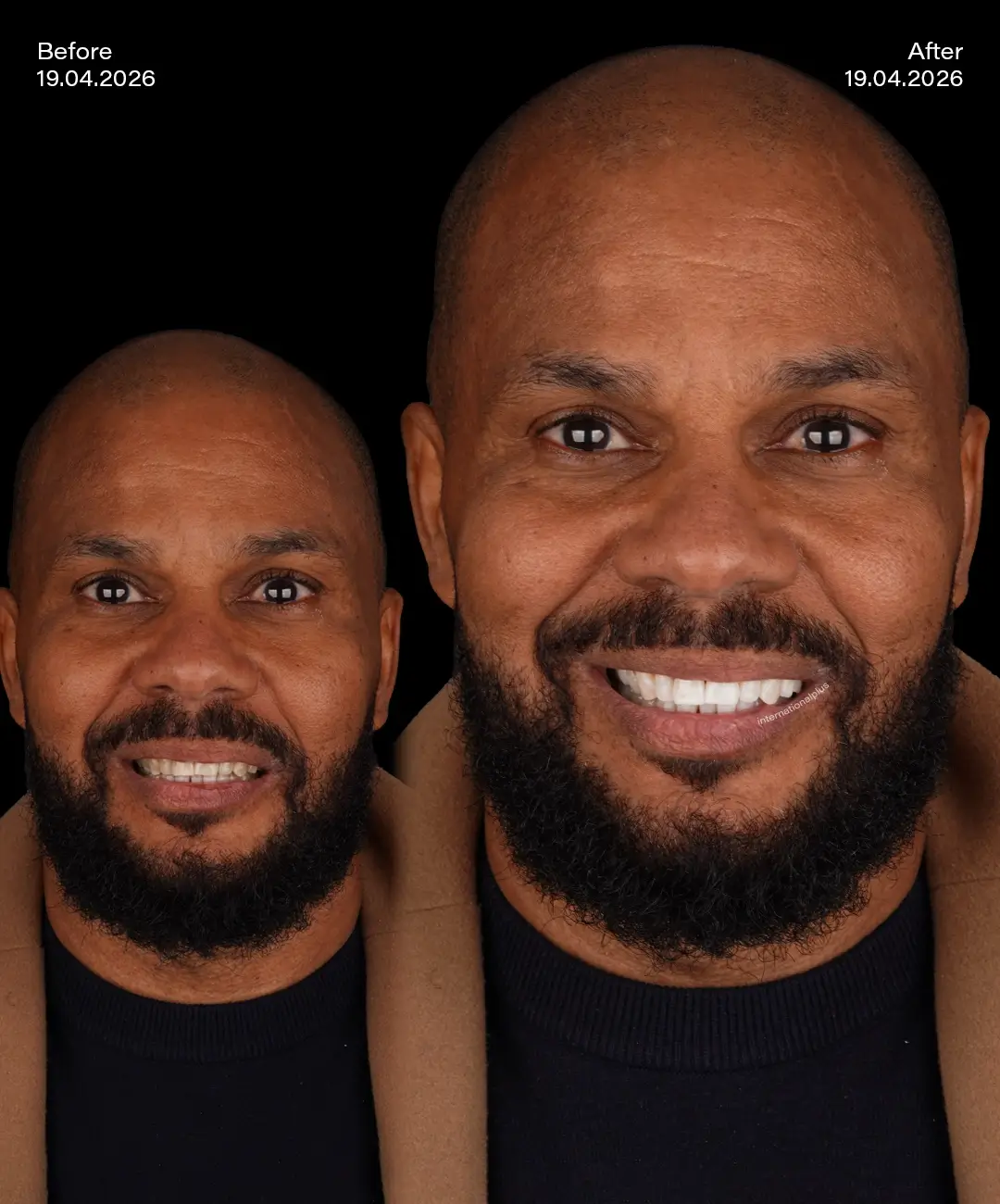 Teeth Whitening Before After 8