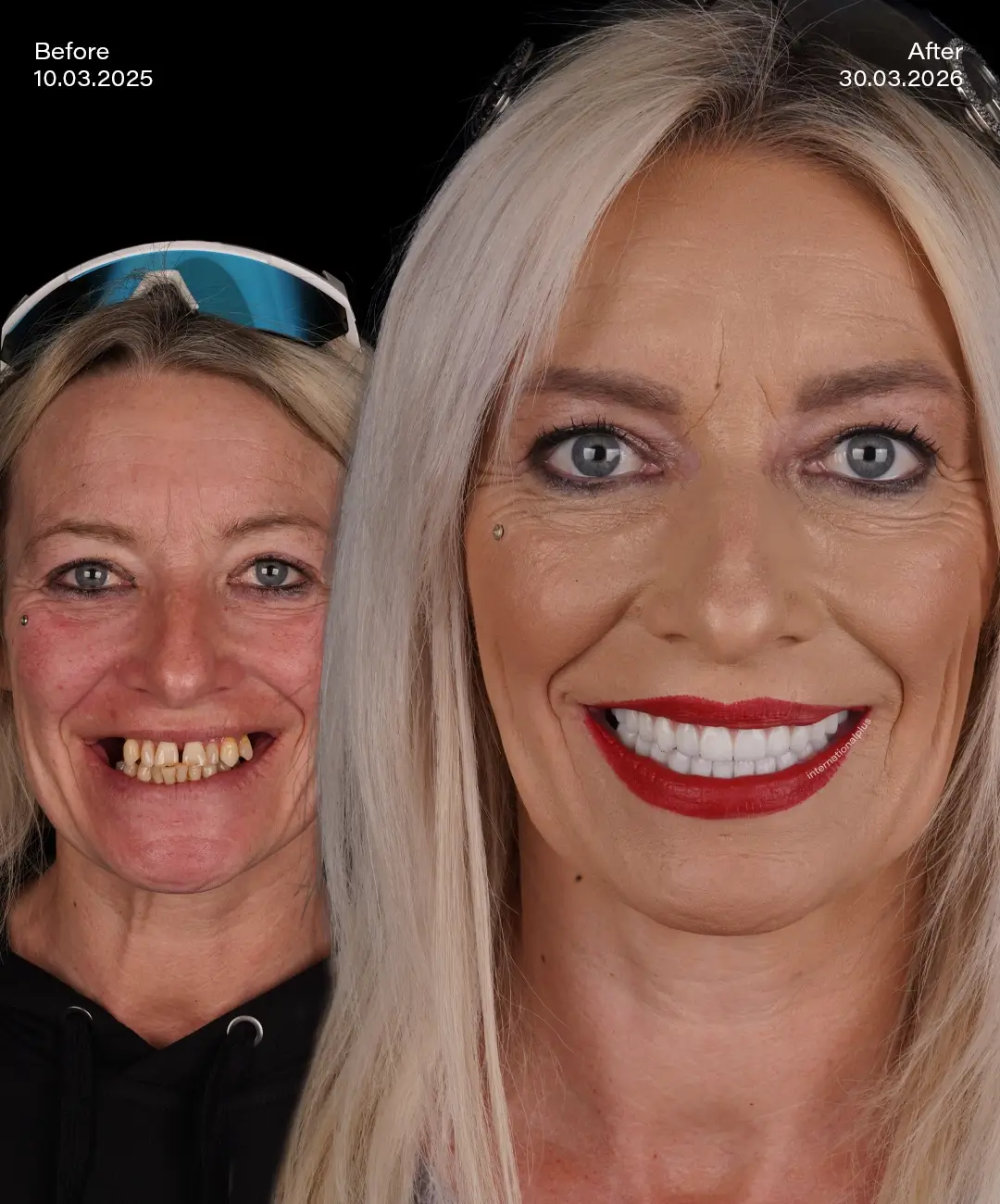 Toronto Dental Systems Before After 3