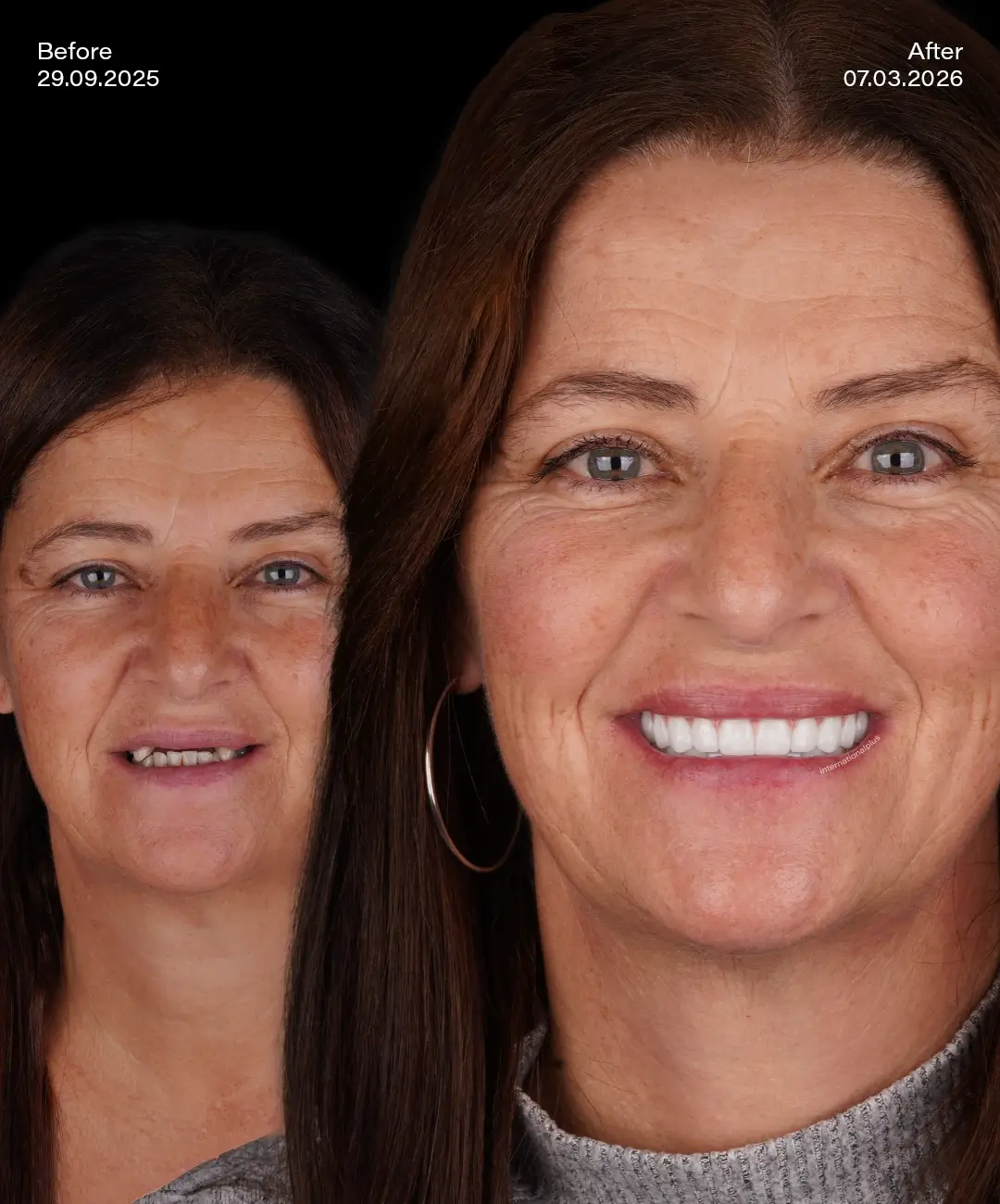 Toronto Dental Systems Before After 4