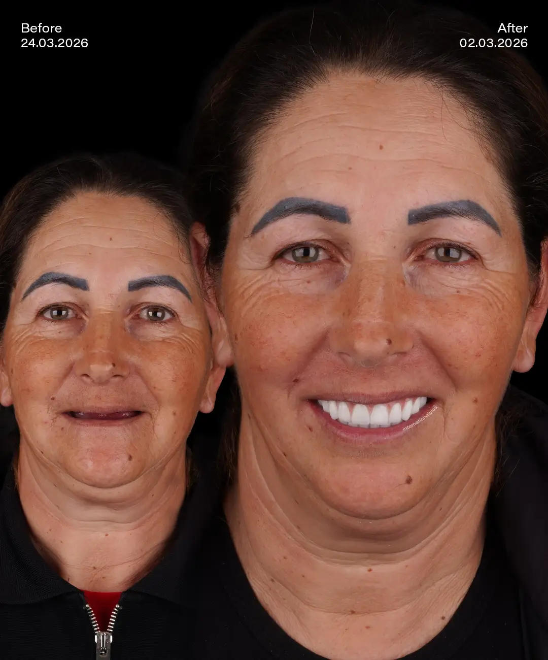 Toronto Dental Systems Before After 5