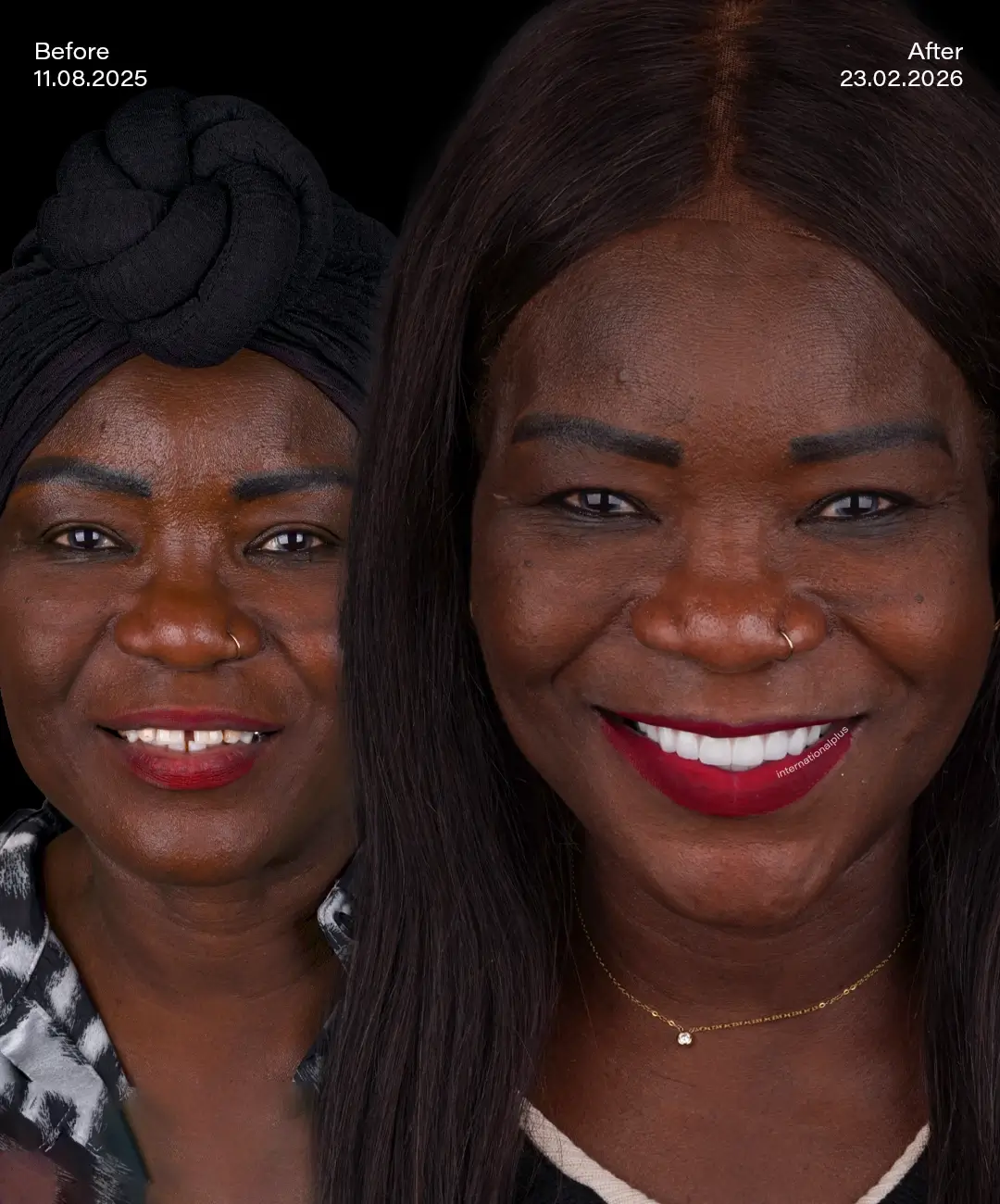 Toronto Dental Systems Before After 6