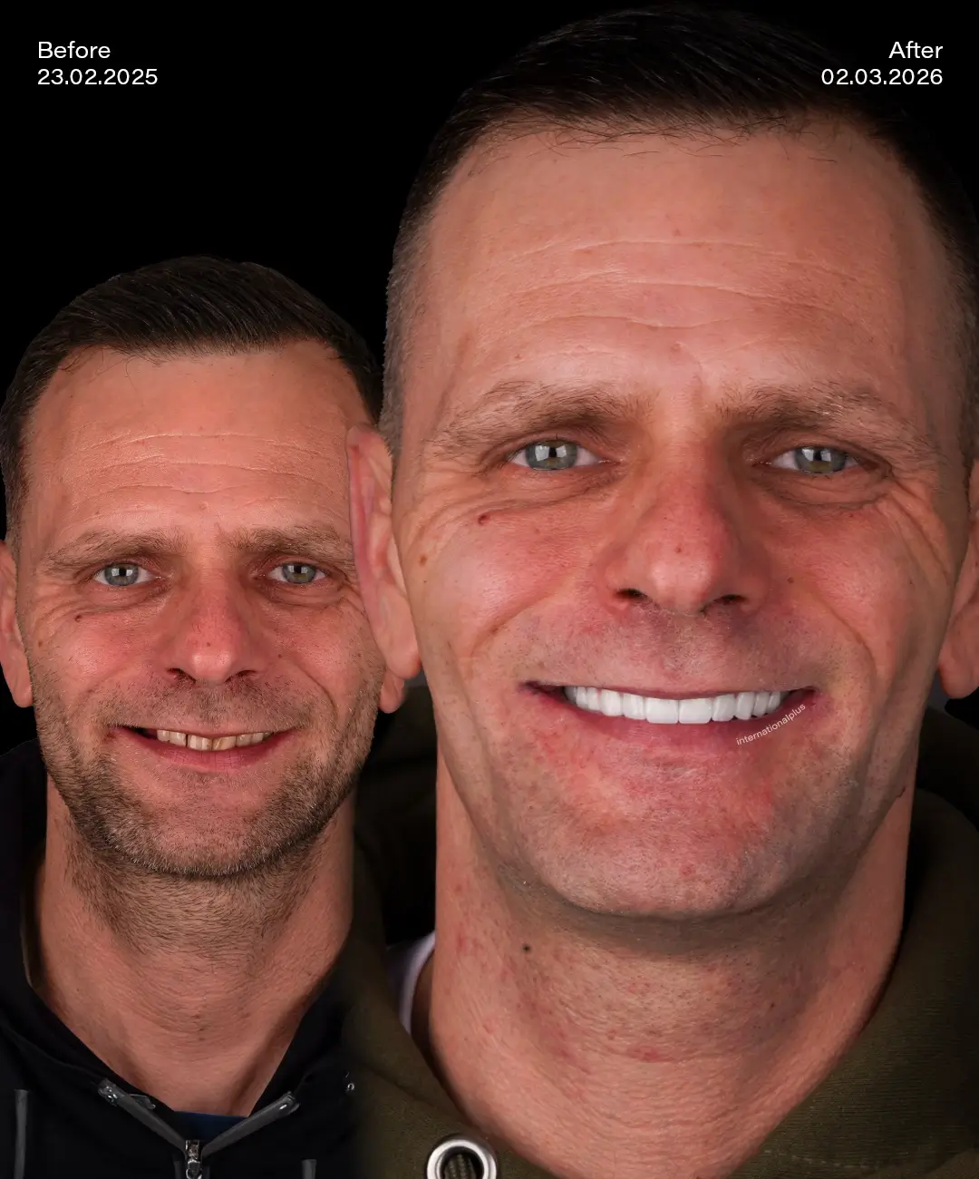 Toronto Dental Systems Before After 8