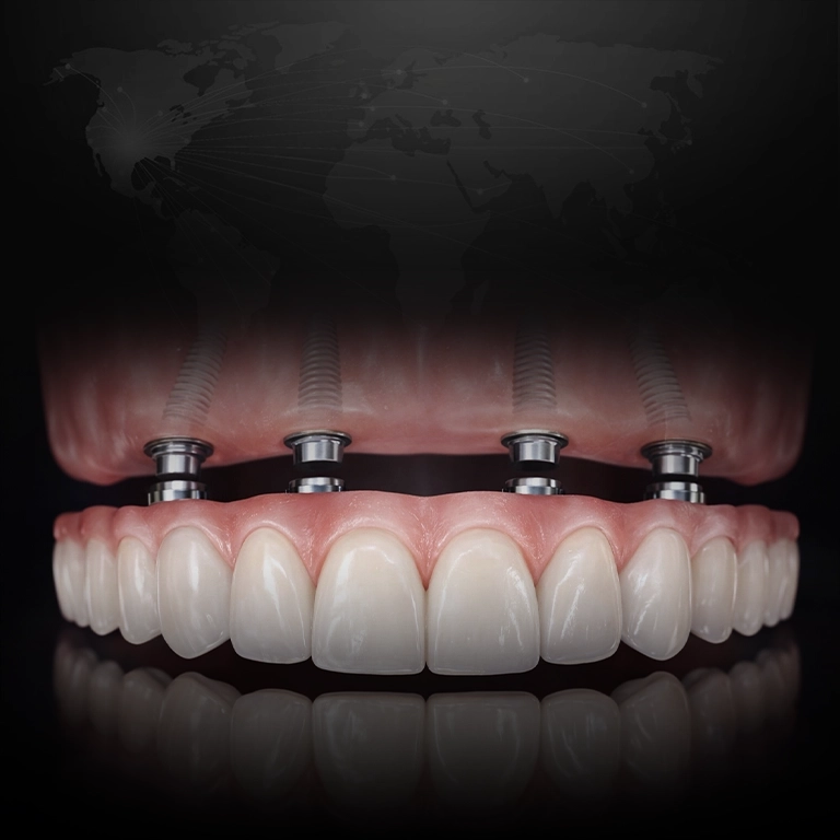What Are All on 4 Implants