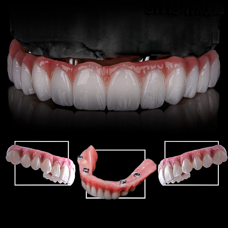 Why Choose Istanbul for All on 4 Implants