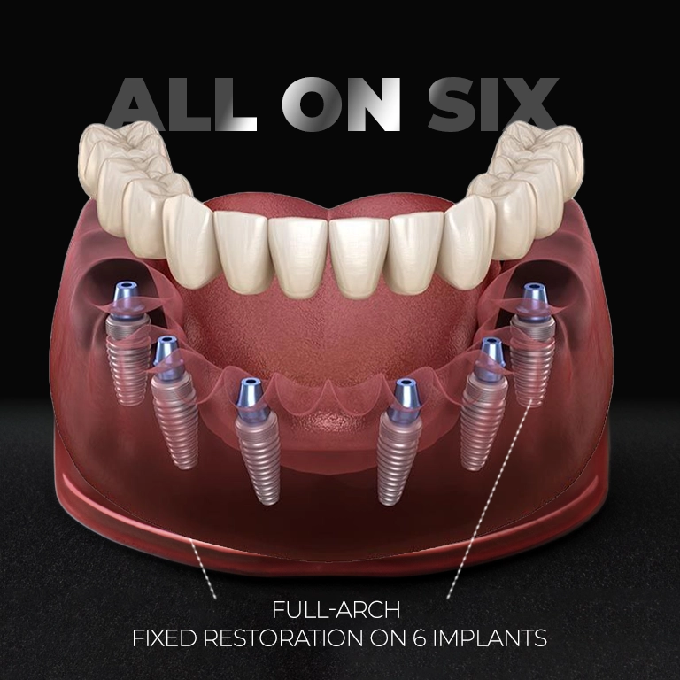 What Are All on 6 Implants