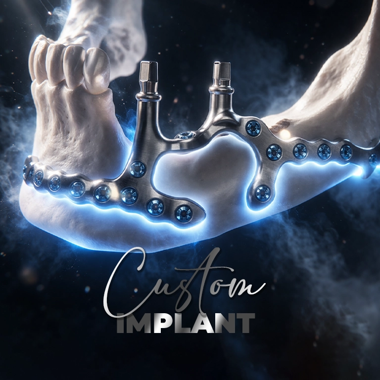 What Are Custom Implant