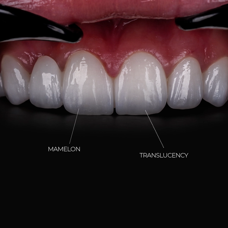 What Are Emax Veneers