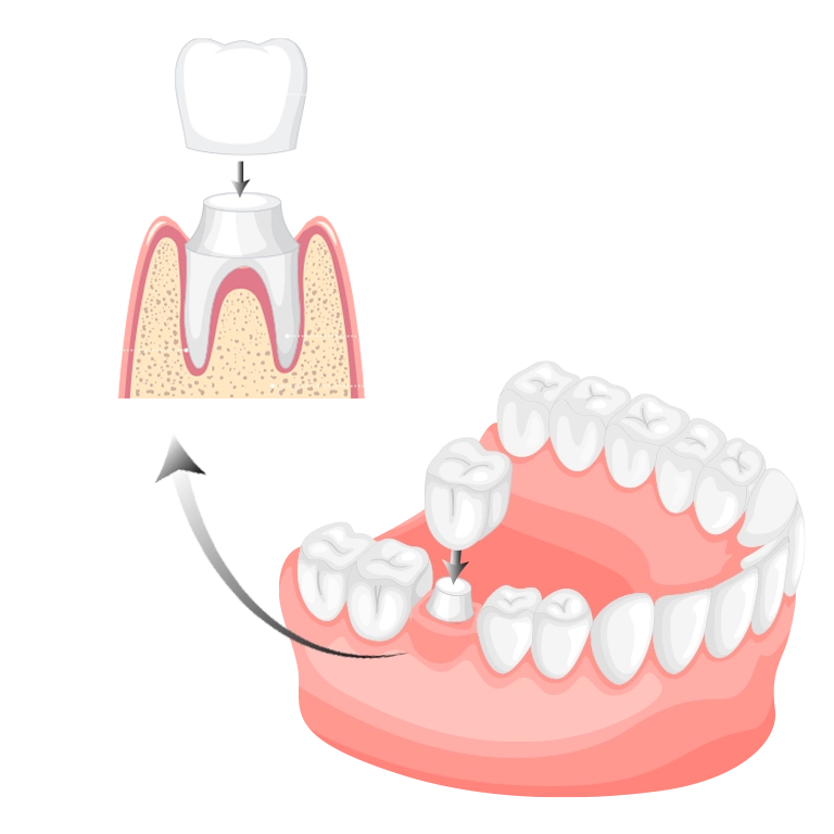 What Are Zirconia Crowns