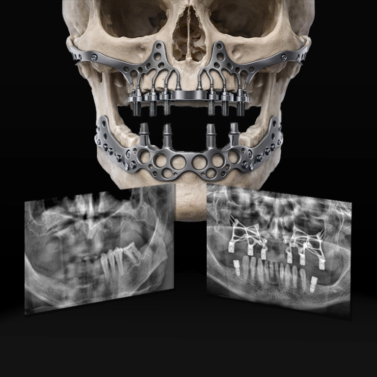 Why Choose Istanbul for Custom Implant