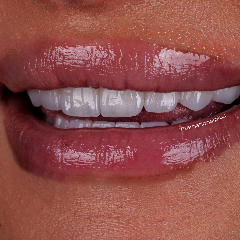 Why Choose Istanbul for Dental Crowns