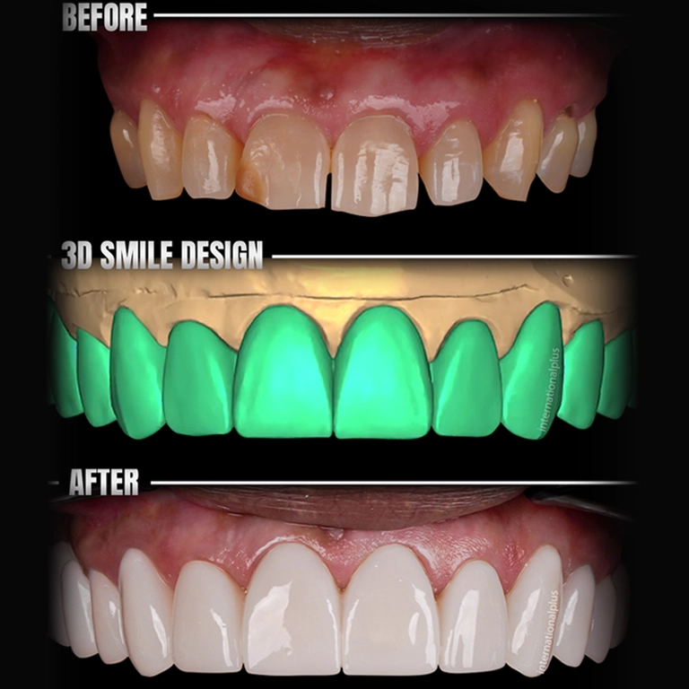 Why Choose Istanbul for Digital Smile Design