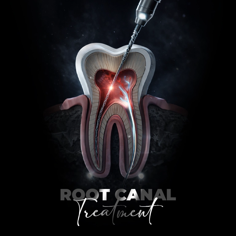 Why Choose Istanbul for Root Canal