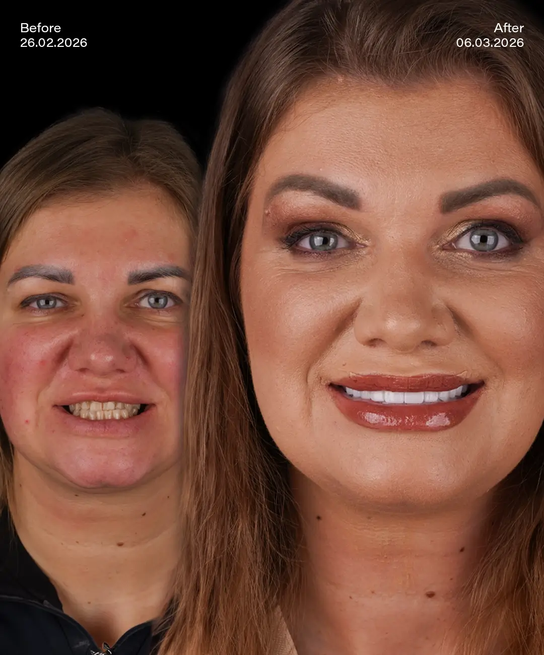 Zirconium Crowns Before After 1