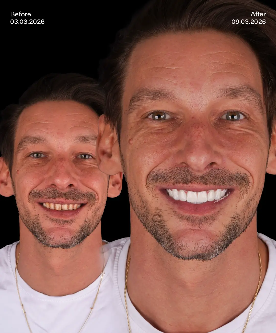 Zirconium Crowns Before After 2