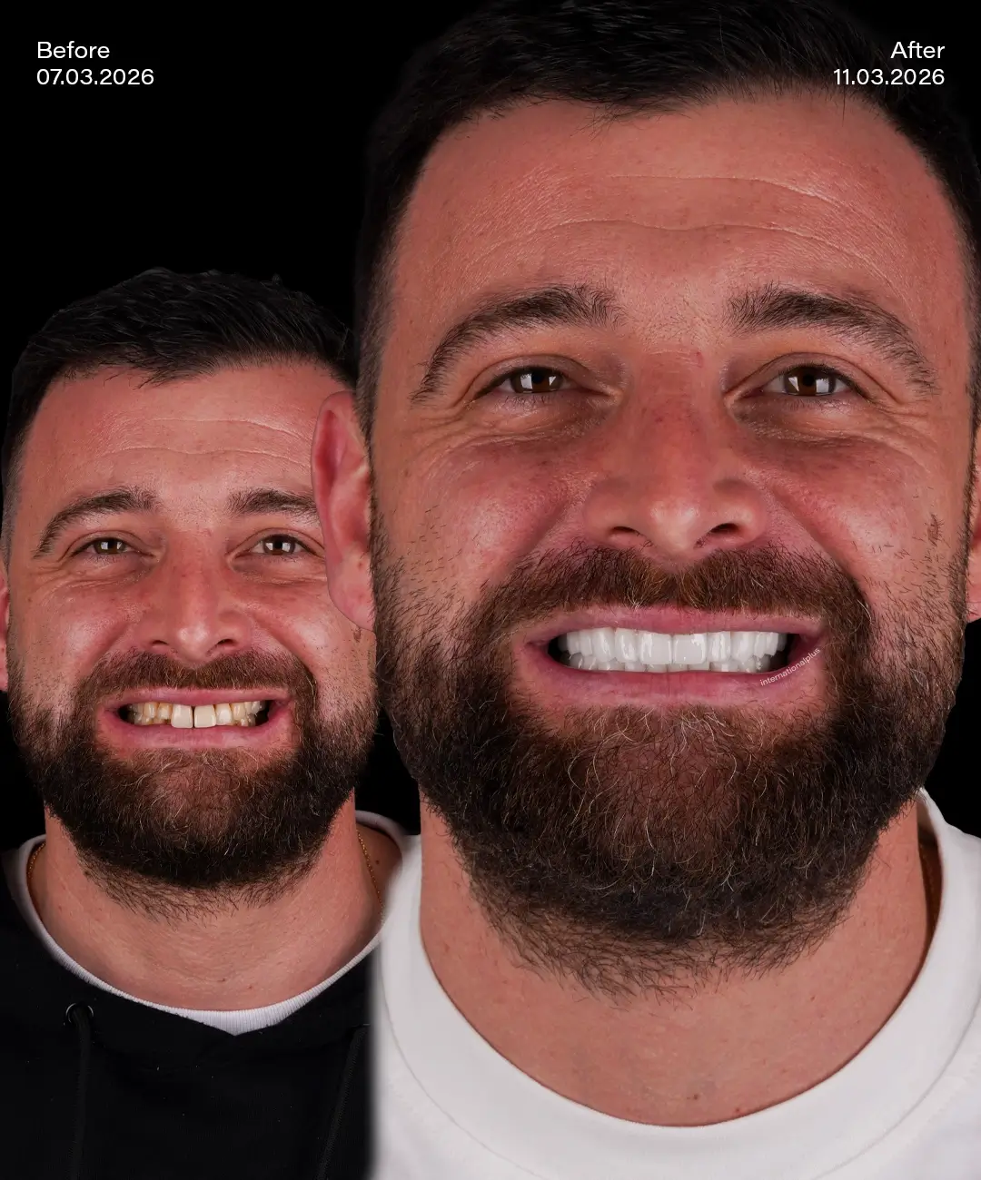 Zirconium Crowns Before After 3