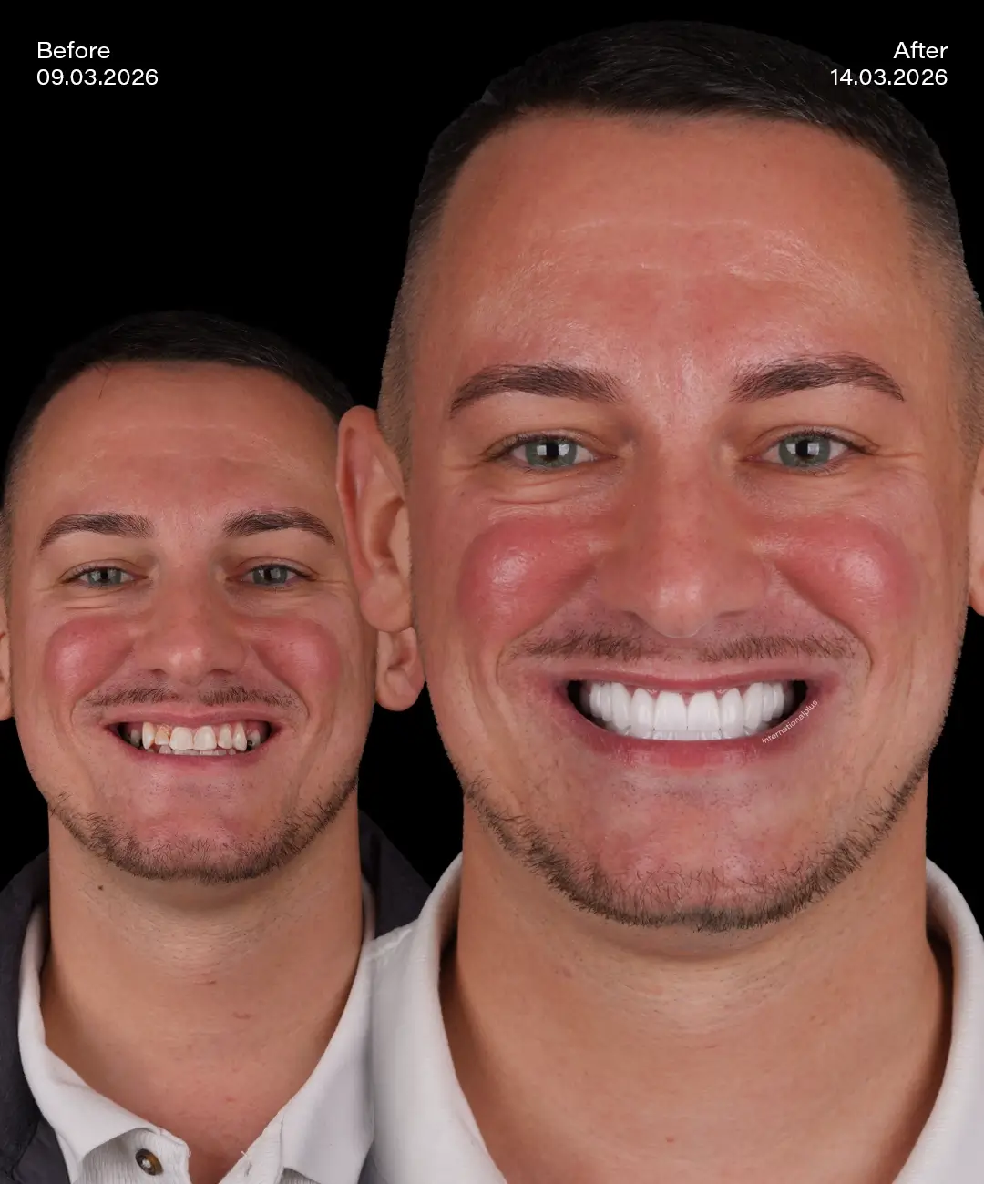 Zirconium Crowns Before After 5