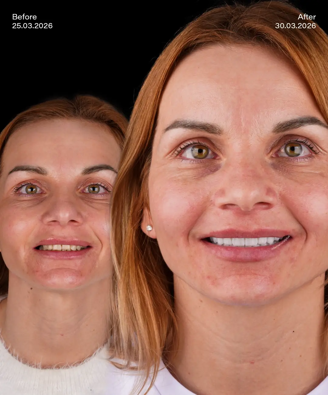 Zirconium Crowns Before After 6