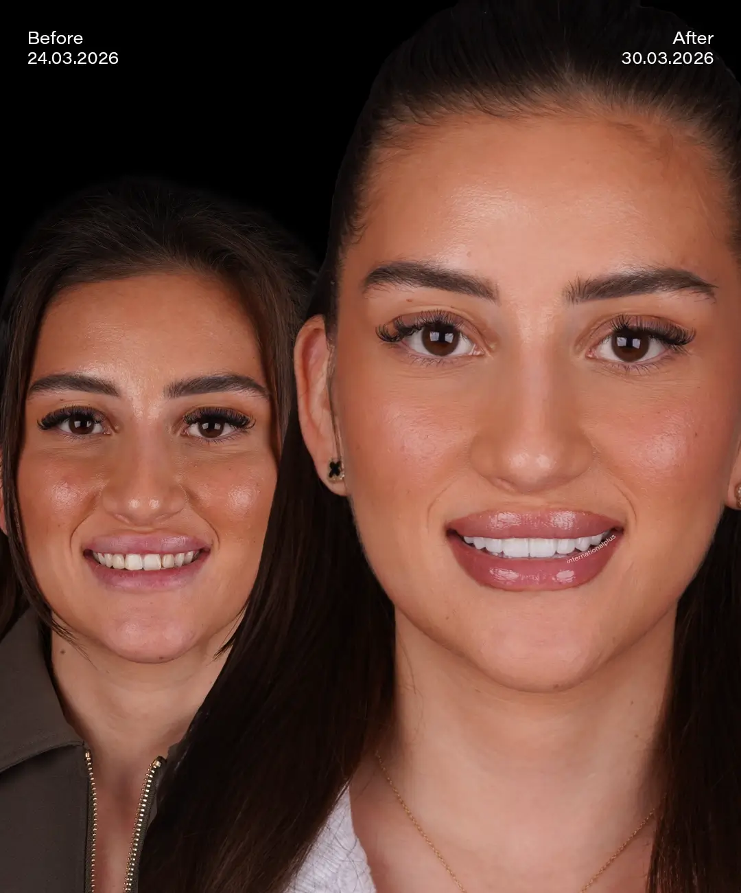 Zirconium Crowns Before After 8