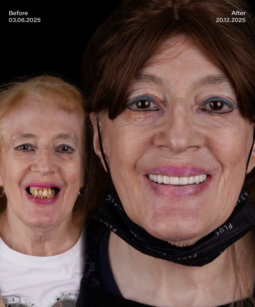 dental-implant-before-after-3