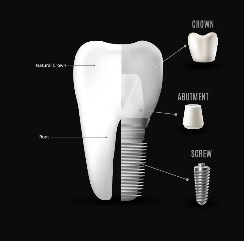 What Are Dental Implants