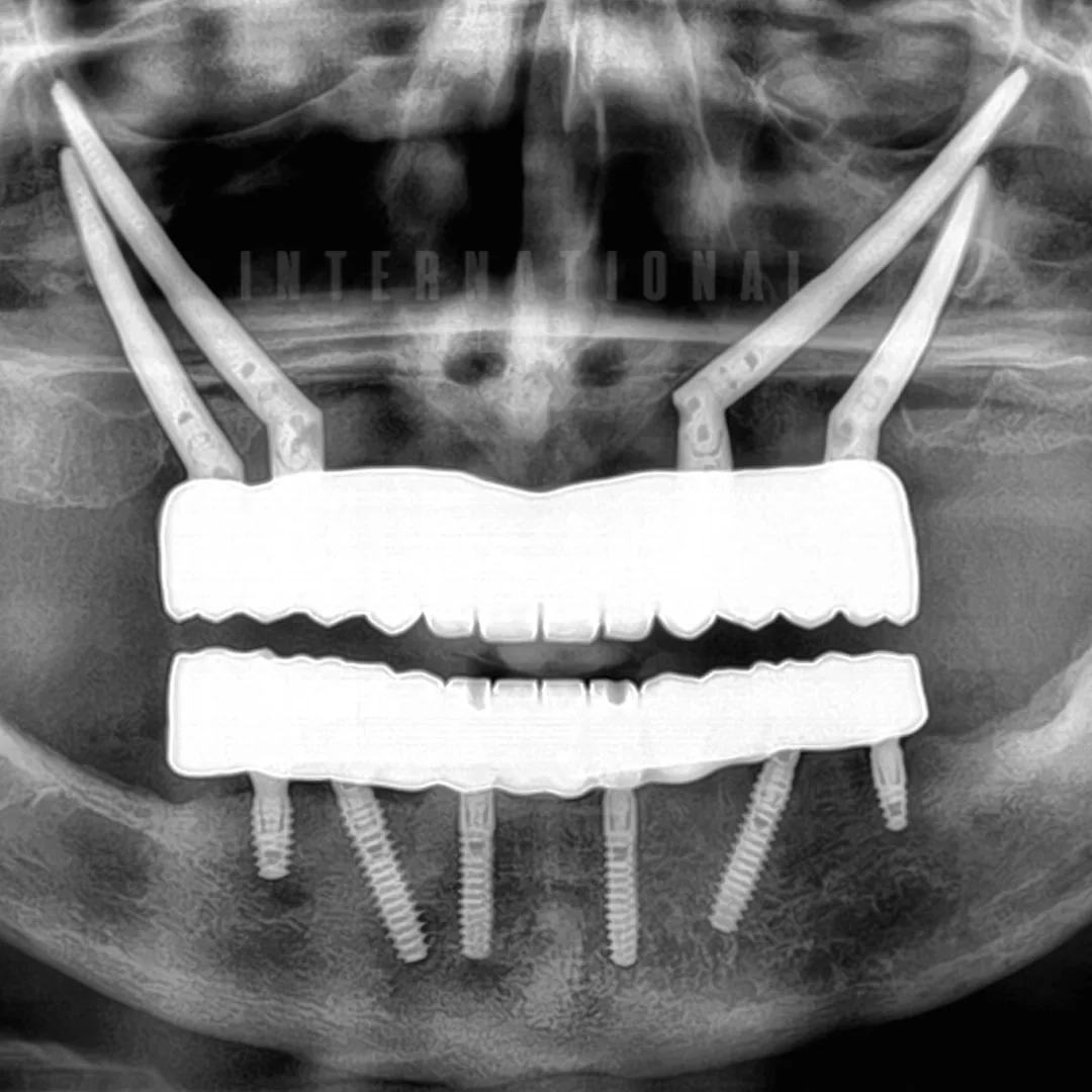 Advanced Surgical Execution Zygomatic Implant Placement and Conventional Implant Integration