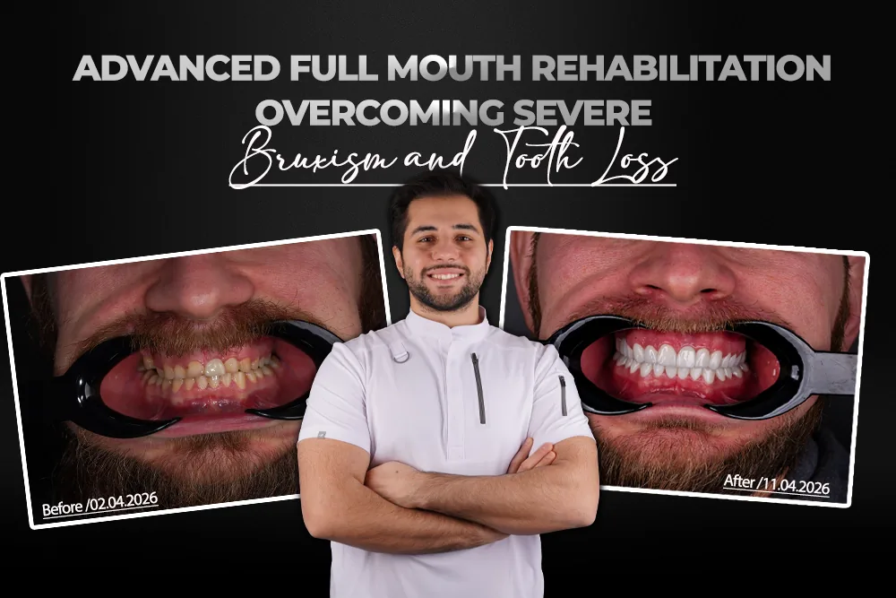Bohdan: Advanced Full Mouth Rehabilitation Overcoming Severe Bruxism and Tooth Loss
