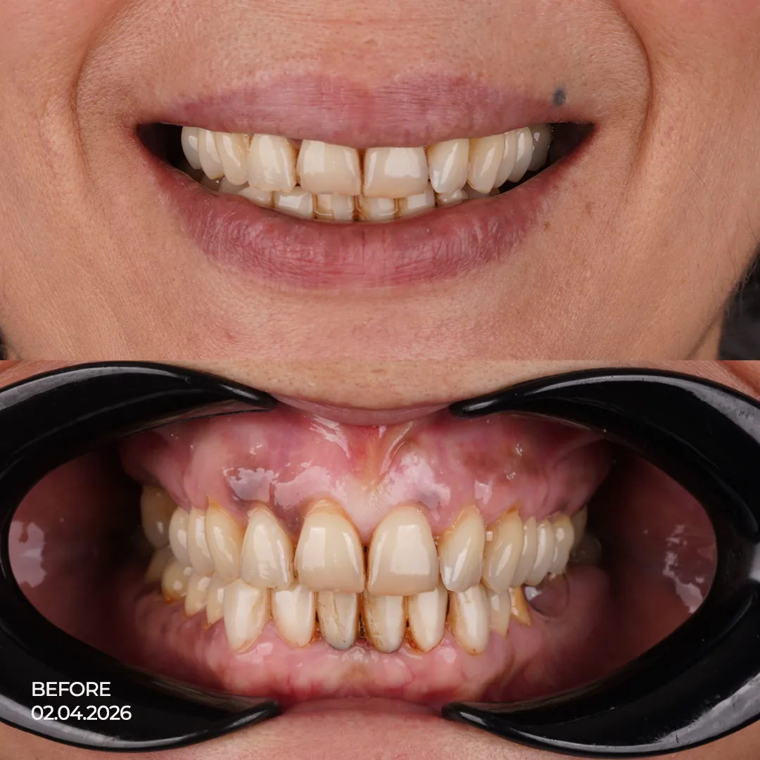 Comprehensive Dental Assessment and Treatment Planning at International Plus Istanbul