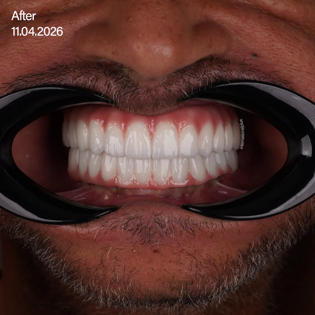 Definitive Zirconia Restoration Precision Fabrication and Final Delivery