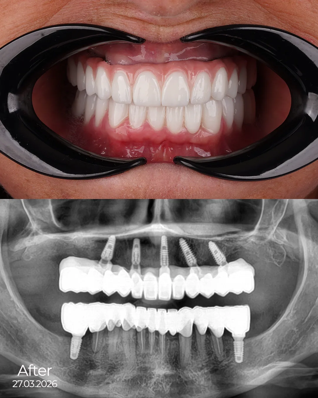 Digital Smile Design with Advanced Technology by Dr. Şehrazat