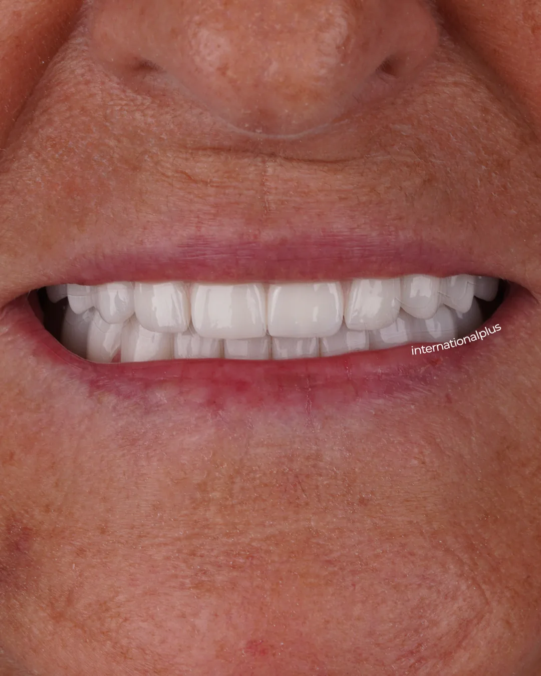 Final Zirconia Restorations and Long-Term Success