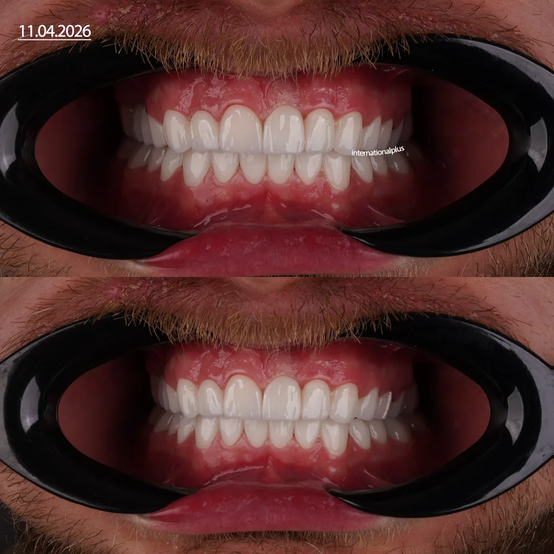 Restoring Vertical Dimension of Occlusion